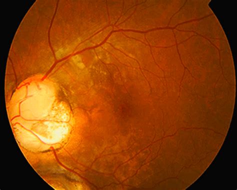 A Guide to Optic Disc Abnormalities with Cheat Sheet