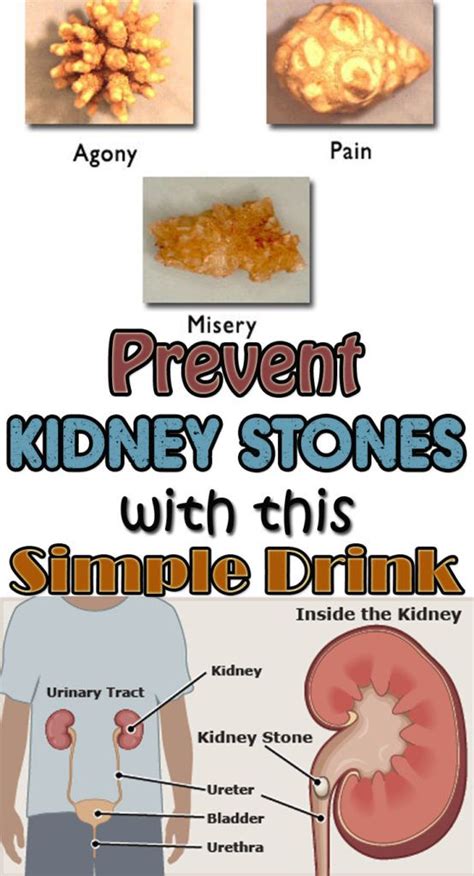 Prevent kidney stones with this simple drink - Page 4 of 4 in 2020 (With images) | Kidney stones ...