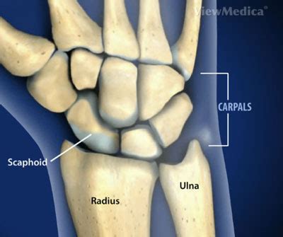 Triquetral Fracture Splint / The triquetral may be fractured by means of impingement from the ...