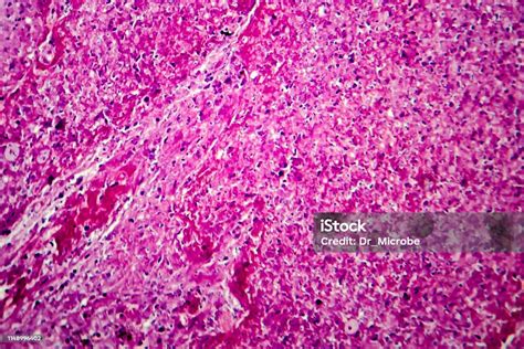 Caseation Of Human Tuberculosis Granuloma Light Micrograph Stock Photo ...