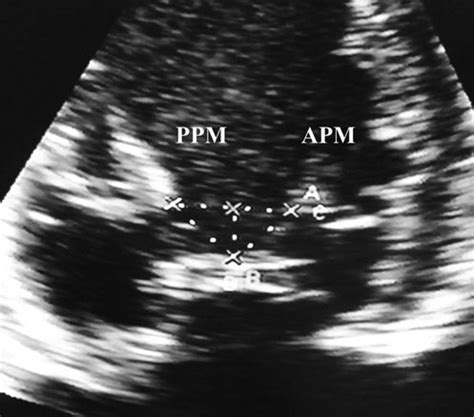 Preoperative echocardiography measurements. The papillary muscle,... | Download Scientific Diagram