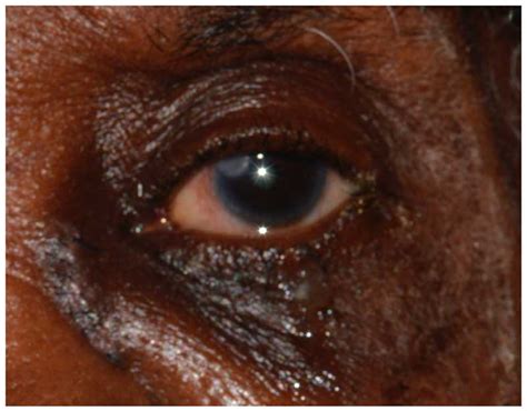 Nasolacrimal duct obstruction secondary to sarcoidosis: