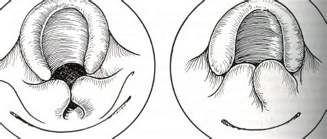 Paediatric Stridor