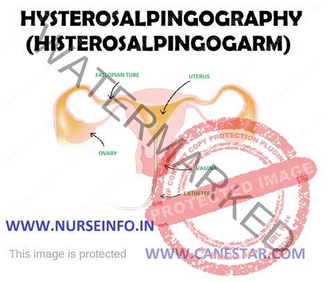 HYSTEROSALPINGOGRAPHY (HYSTEROSALPINGOGRAM) - Nurse Info