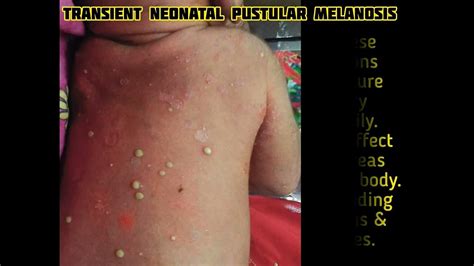 Transient Neonatal Pustular Melanosis. - YouTube