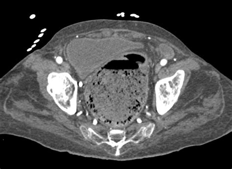 Stercoral Colitis - Colon Case Studies - CTisus CT Scanning