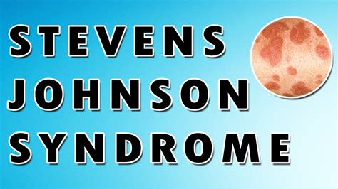 Stevens Johnson Syndrome