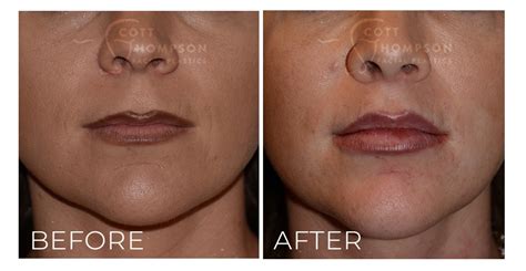 Lip Lift in SLC Utah | Plastic Surgery | Utah Facial Plastics