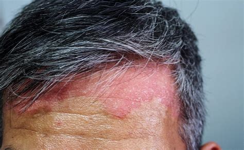 Can Diabetes Cause Scalp Psoriasis - DiabetesWalls