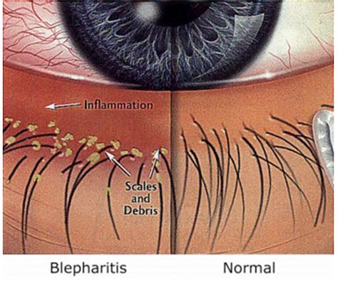 Blepharitis Toms River | Dry Eye Syndrome Freehold - Brick, NJ