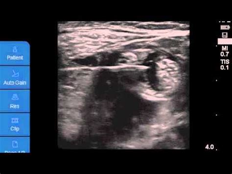 Ultrasound-guided Continuous Popliteal Nerve Block - YouTube