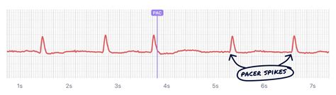 What Paced Rhythm Looks Like on Your Watch ECG | Qaly