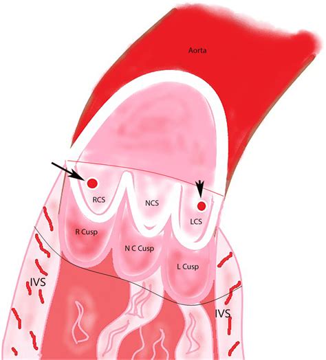 Diagram of longitudinally opened aortic root demonstrates normal ...