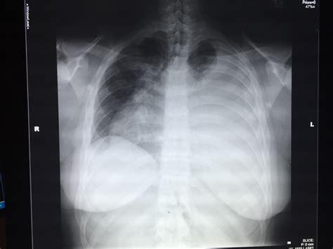 Ultrasound Limited by Large Body Habitus – Radiology In Plain English