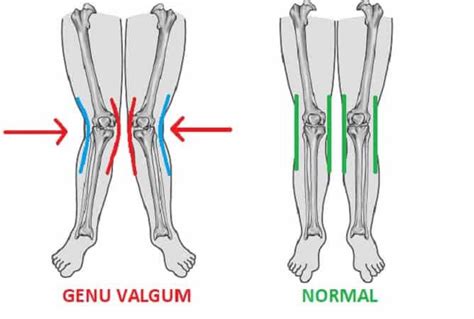 Knock Knees - Peak Podiatry