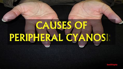 CAUSES OF PERIPHERAL CYANOSIS - YouTube