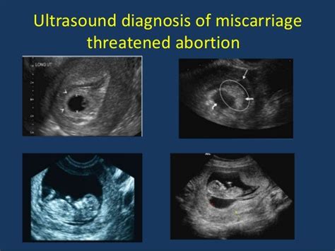 First trimester ultrasound