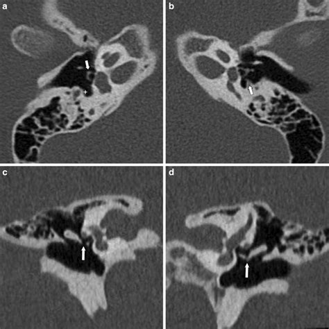 Congenital absence of pyramidal eminence and stapes tendon with CT ...