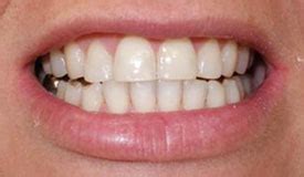 Before & After Photos – In-Line Invisible Braces