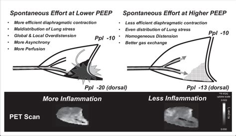 Lower PEEP in severe ARDS presents more lung collapse, resulting in ...