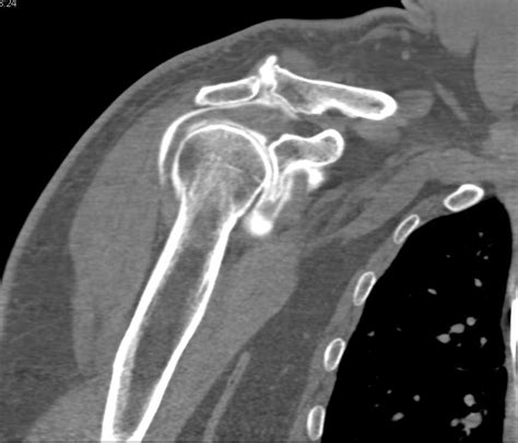 Mri Arthrogram Shoulder Rotator Cuff Tear