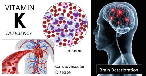 Vitamin K Deficiency Symptoms Skin