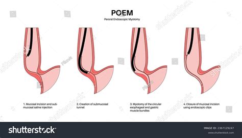 Peroral endoscopic myotomy. POEM minimally - Royalty Free Stock Vector 2367129247 - Avopix.com