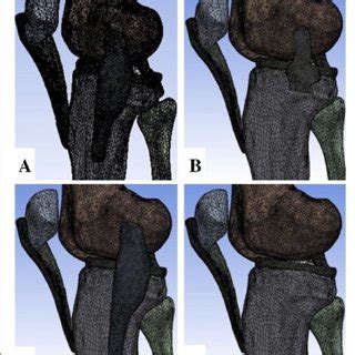 Four cases of MCL deficiency. a Case 1: intact MCL. b Case 2: SMCL... | Download Scientific Diagram