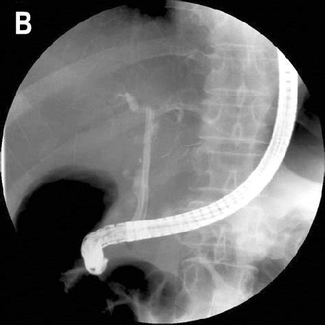 A case of anastomotic stricture in a living donor liver... | Download Scientific Diagram