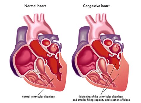 What is Congestive Heart Failure? - University Health News