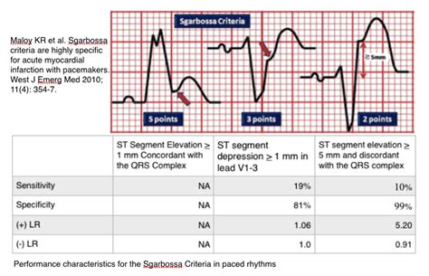 ST Elevation Myocardial Infarction in LBBB – Core EM