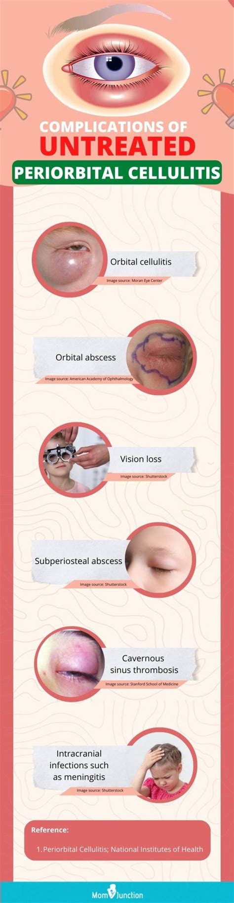 Preseptal Cellulitis Vs Orbital Cellulitis