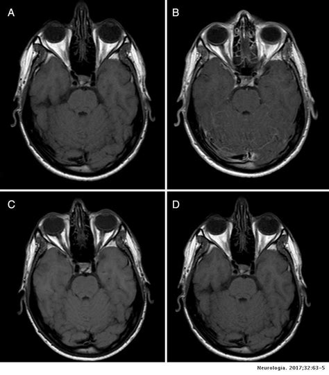 Focal leptomeningeal uptake, a new radiological finding in ...