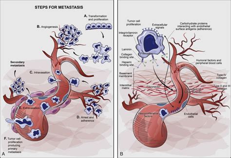 Metastatic Tumors in Bone | Basicmedical Key