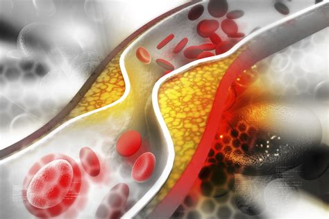 Many ways to lower cholesterol will reduce heart disease risk - Harvard Health