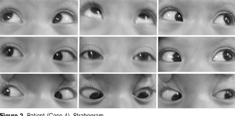 Figure 1 from [Skew deviation. Strabismological diagnosis and treatment alternatives ...