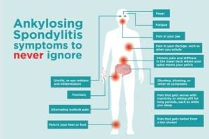 Common Ankylosing Spondylitis Signs and Symptoms