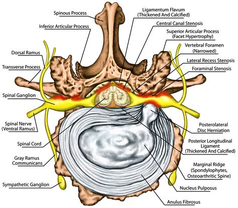 Degenerative disk disease causes, symptoms, diagnosis, exercises & treatment