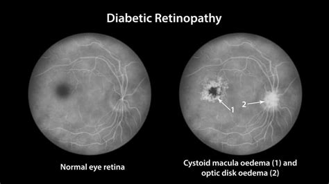 Cystoid Macular Edema Macon | Retina Treatment Warner Robins, GA