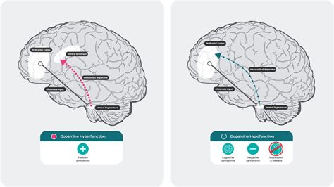 Neurochemical basis of schizophrenia