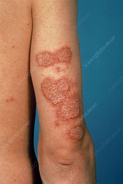 Discoid eczema affecting upper arm - Stock Image M150/0025 - Science ...