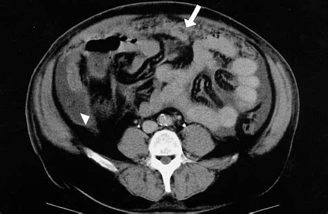 Malignant Ascites | Oncology | JAMA Internal Medicine | The JAMA Network