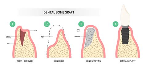 Dental Bone Graft Healing Stages | Raio Dental