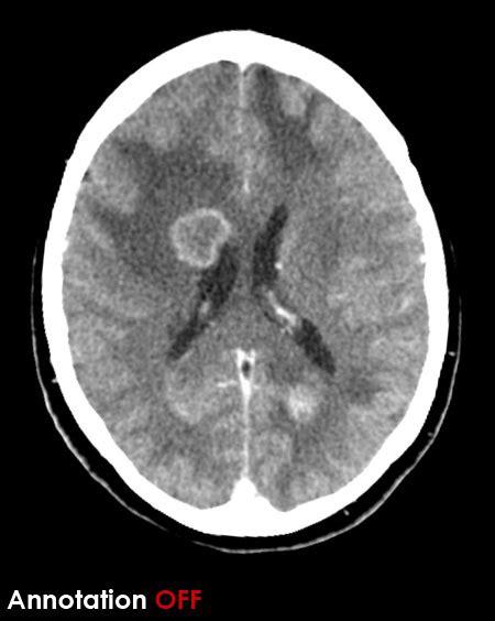 CT Brain - Scroll image gallery - Cerebral metastases