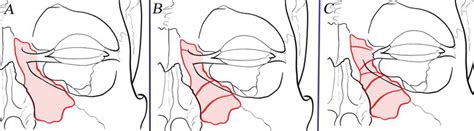 Maxillofacial Fractures: From Diagnosis to Treatment | IntechOpen