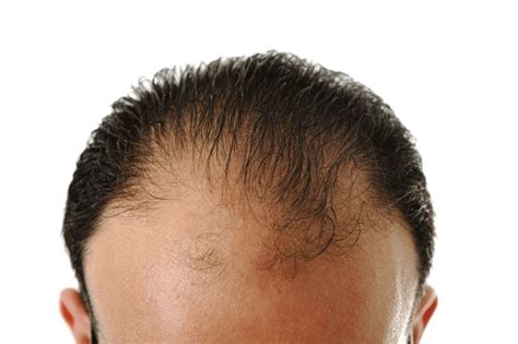 What Causes Hair Loss in Men and How to Treat it