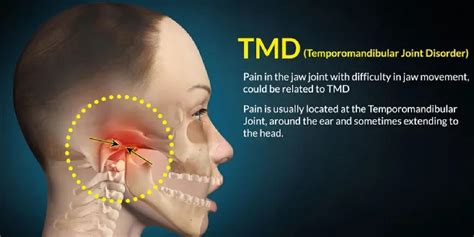 Jaw Pain / TMD - Neocare