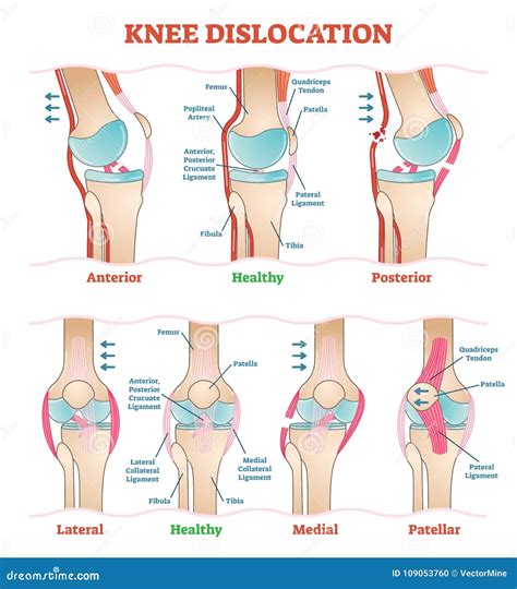 Knee Dislocations - Medical Vector Illustration Diagrams. Anatomical ...