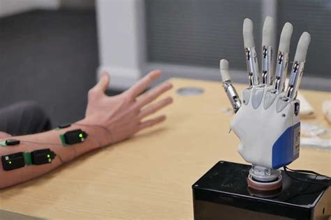 Modern prosthetic hands are fantastic — so why are they not more widely used? | by Keele ...