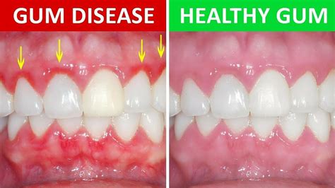 Herbal Dentist Super Potent Gum Disease Cure Stop Bleeding Receding Gums Teeth | eBay